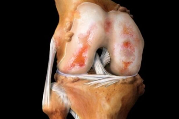 Destruction of the knee joint due to arthrosis - a common pathology of the musculoskeletal system