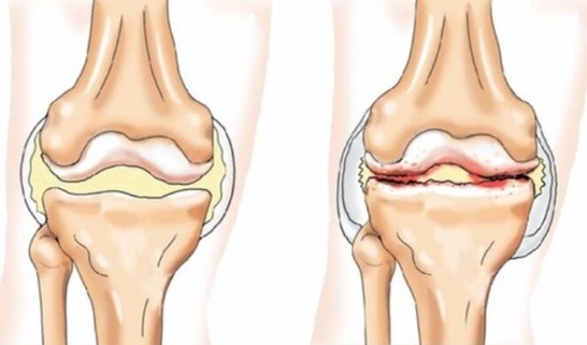 Differences in arthritis and arthrosis