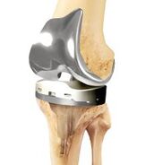Joint prosthetics