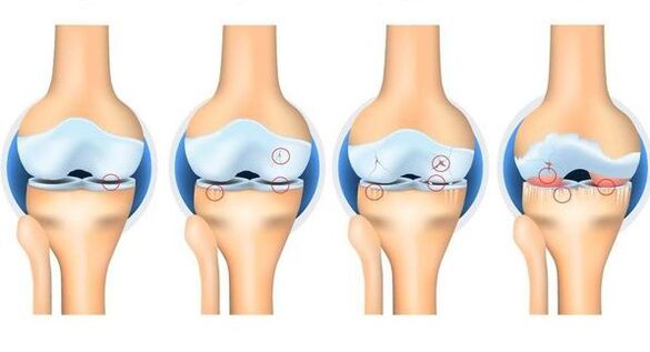 Stages of osteortrosis