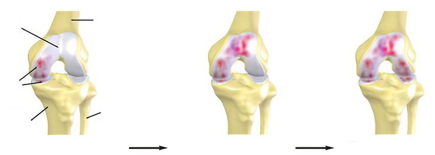 Stages of arthrosis