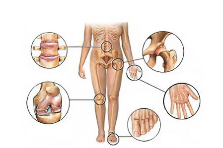 Types of arthrosis