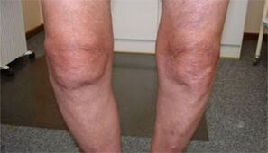 symptoms of arthrosis