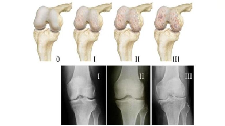 Stages of arthrosis of the knee joint on x-rays
