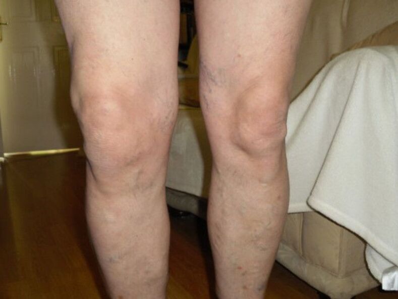 healthy knee and arthrosis of the knee joint