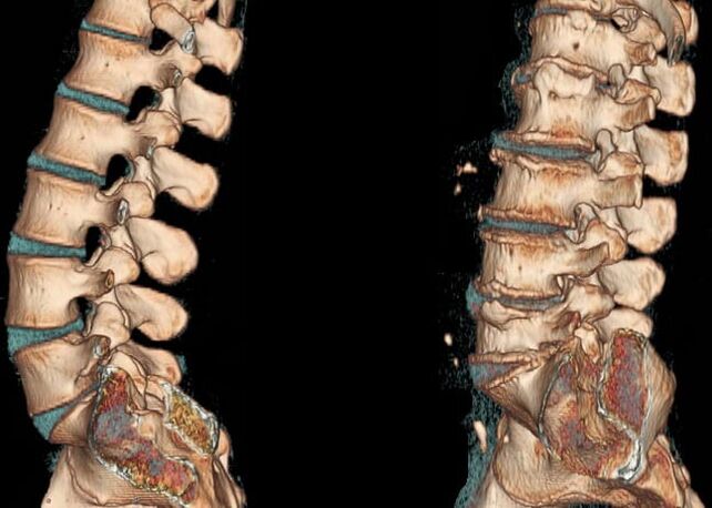 CT scan of the lumbar spine in normal conditions and with osteochondrosis