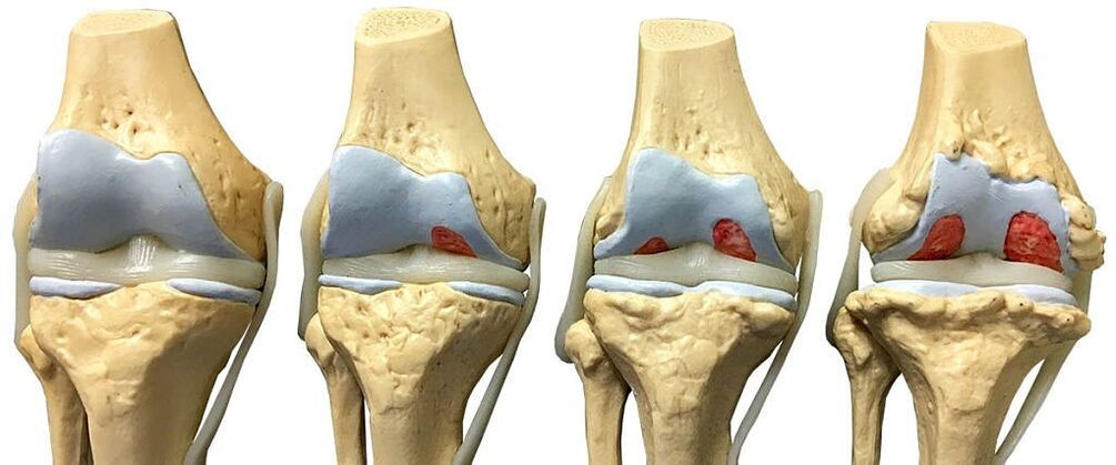 Degrees of arthrosis of the knee joint