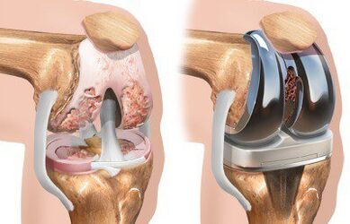 Endoprosthetics of the knee joint with gonarthrosis